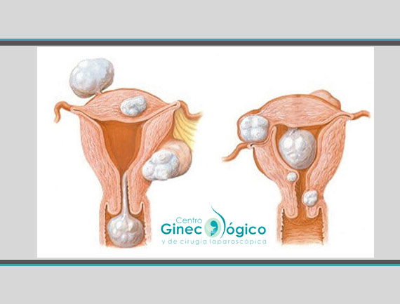 Tratamiento de miomas Uterinos - Ginecólogos CDMX
