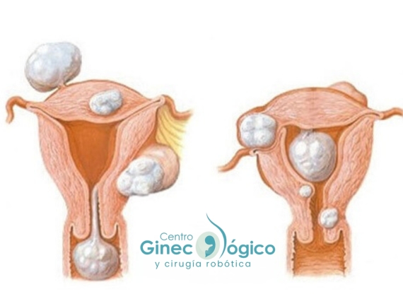 Tratamiento de miomas Uterinos - Ginecólogos CDMX